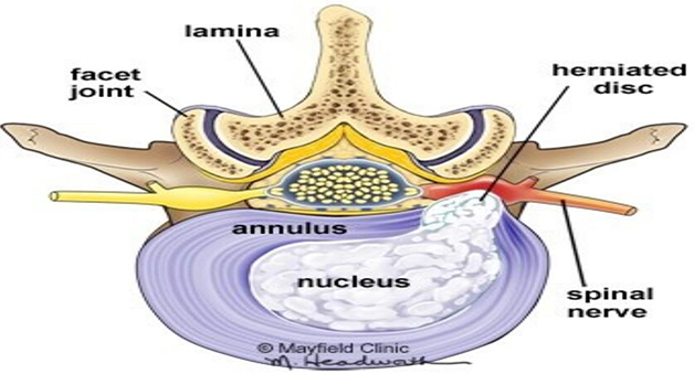 脊柱内镜微创椎间盘切除术