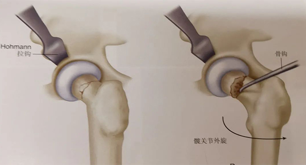 股骨近端骨折桥接内固定术