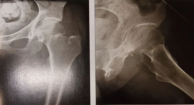 骨质疏松性椎体骨折椎体成形术