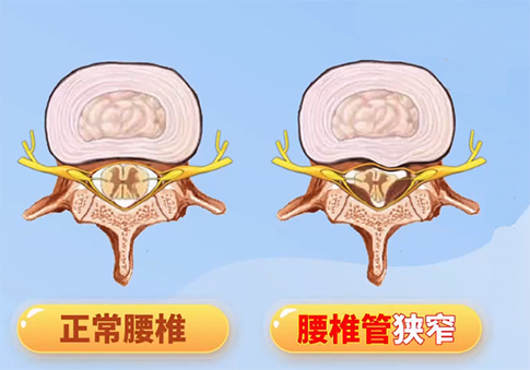 腰椎管狭窄椎管减压术