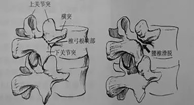 &ldquo;腰椎滑脱&rdquo;和&ldquo;腰椎间盘突出&rdquo;有啥区别？