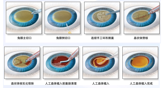 眼科医院做白内障手术多少钱？