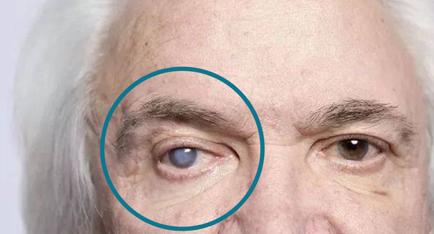 引起白内障的因素有哪些？