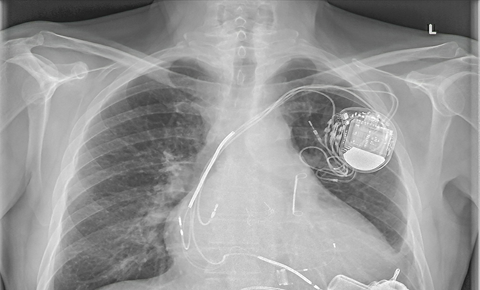 永久性起搏器植入术