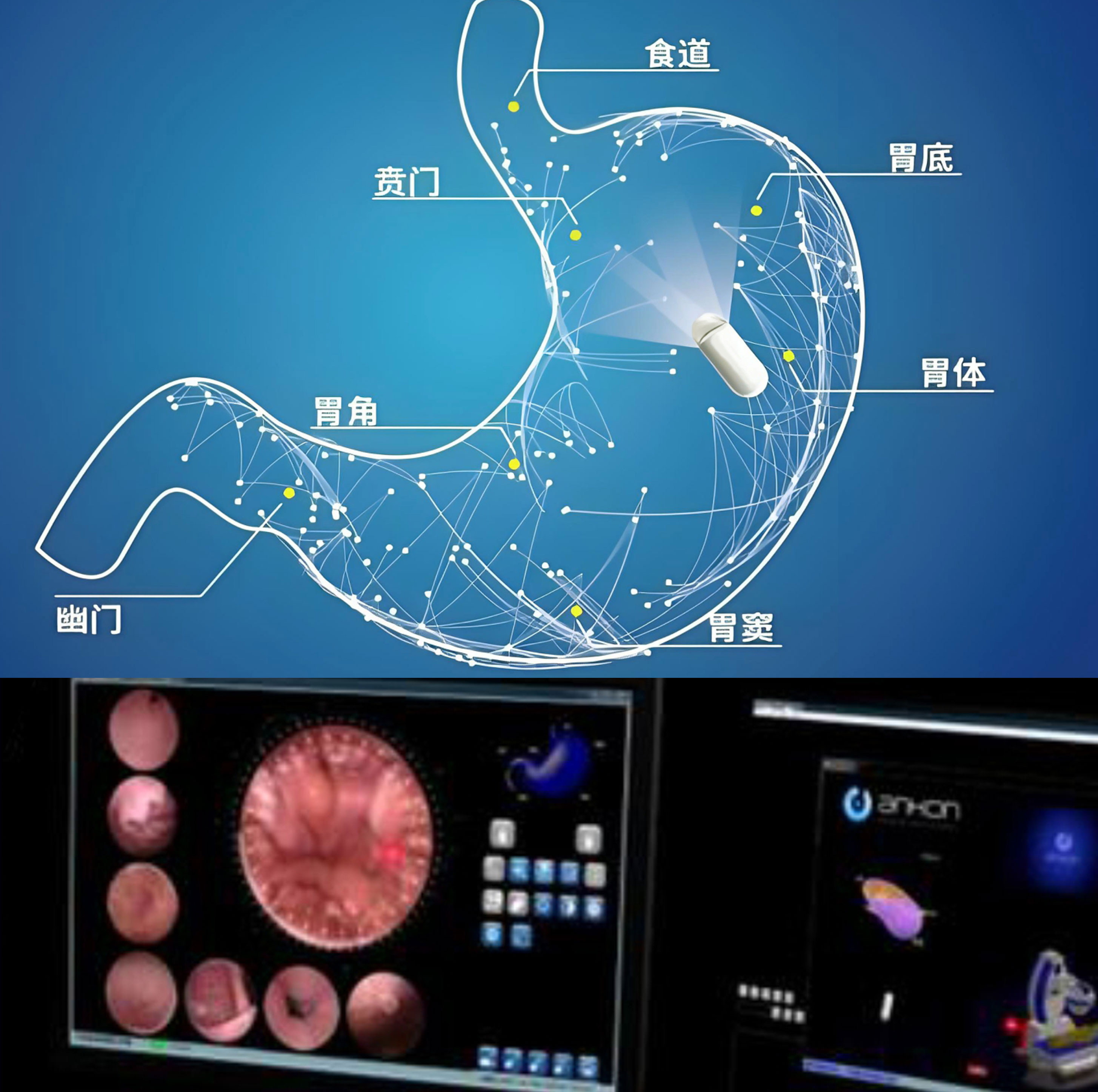 磁控胶囊胃镜、胶囊肠镜