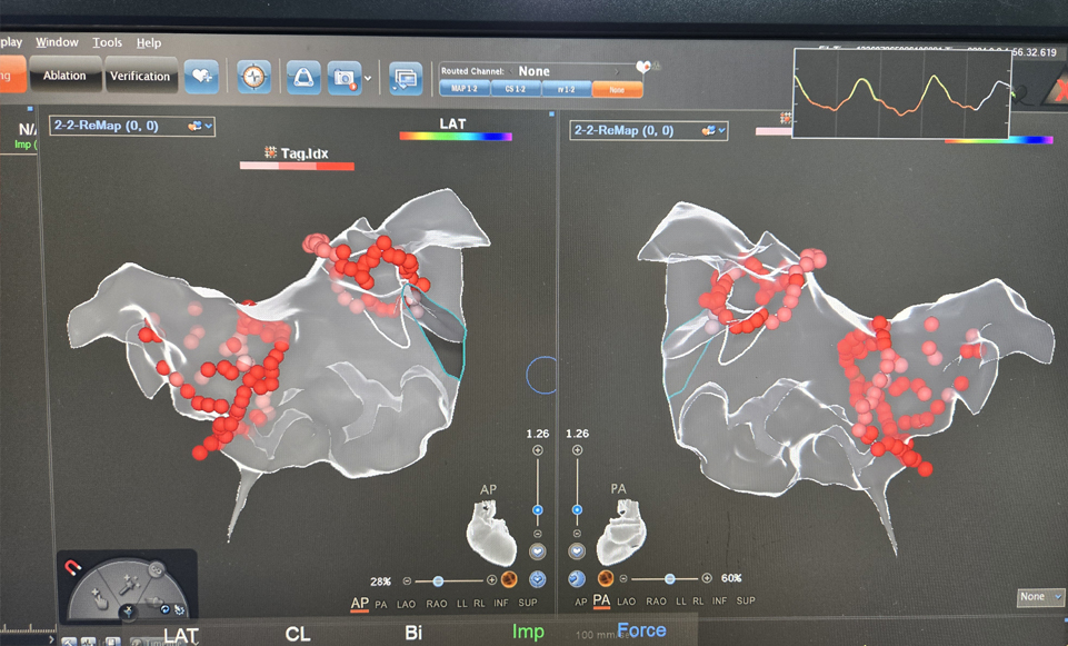 房颤消融+左心耳封堵”一站式手术医生