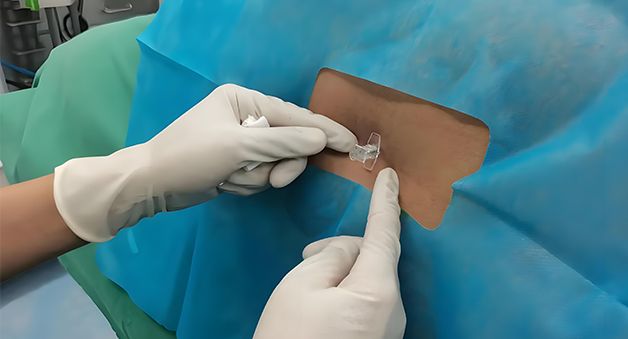 腰硬联合神经阻滞麻醉+局部神经阻滞麻醉