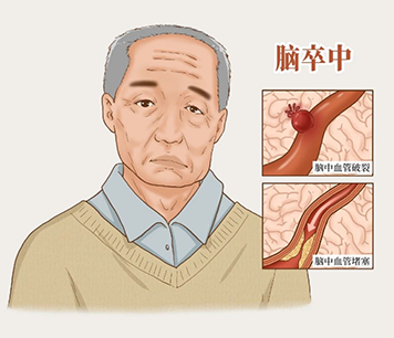 缺血性脑卒中早期预警