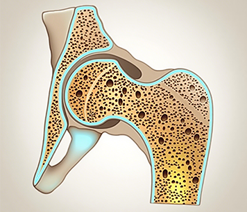 骨质疏松症诊疗