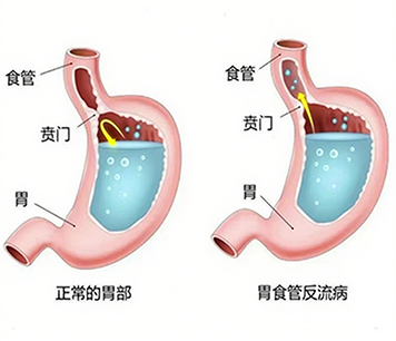 食管、贲门疾病