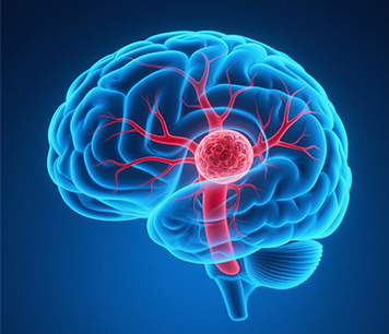 脑梗为何复发？这些情况是“帮凶”医生