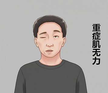 重症肌无力