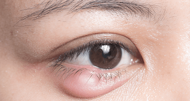 麦粒肿用什么眼药膏