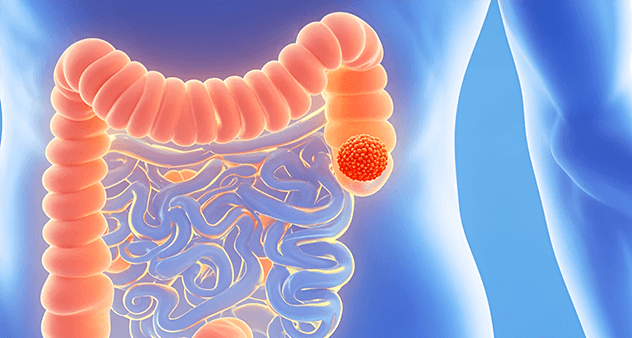 结肠炎容易导致成哪些并发症