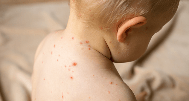 过敏体质看过来：常见过敏性疾病有哪些？