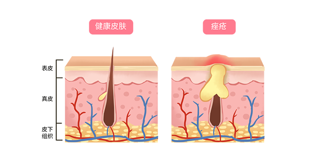 关于痤疮，你想知道的都在这里！
