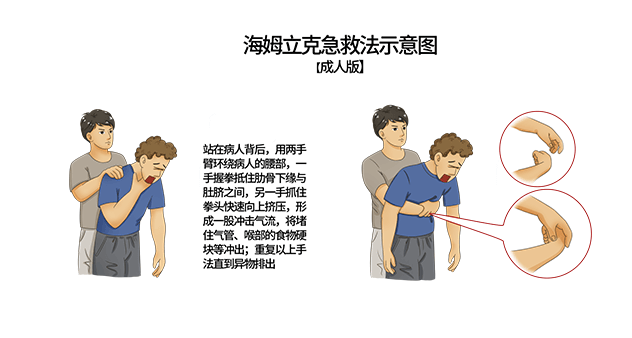 异物卡喉怎么办，快用海姆立克急救法