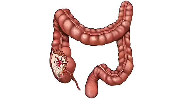便血 &rarr; 肠癌，要警惕！从便便颜色看健康！医生