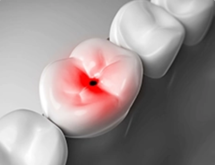 给成都人的夜间护齿指南：火锅奶茶后，如何打赢口腔&ldquo;保卫战&rdquo;？医生