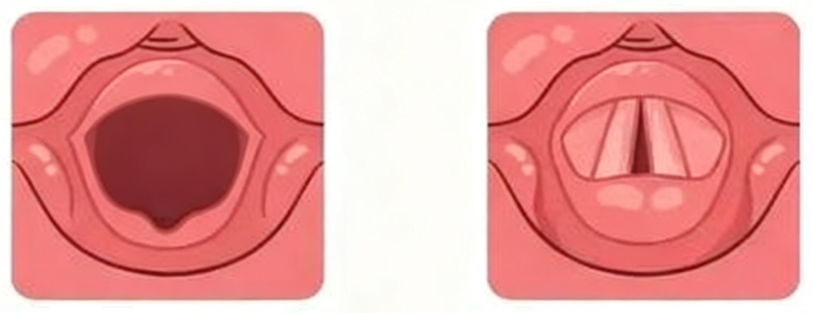 急性喉炎｜30分钟可致命！冬季高发！警惕&ldquo;犬吠样&rdquo;咳嗽医生