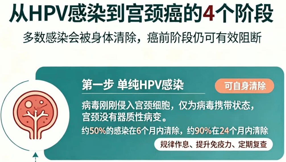 从感染HPV到成为宫颈癌，需要多久？
