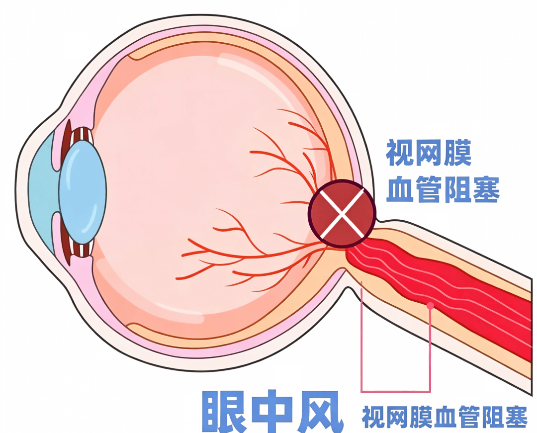 95后宝妈一觉醒来右眼失明！医生：很难恢复！你也可能正在做