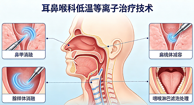 耳鼻喉科低温等离子治疗技术